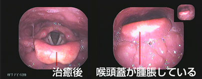 急性喉頭蓋炎症例2