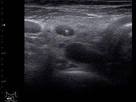 甲状腺腫瘍のエコー画像2