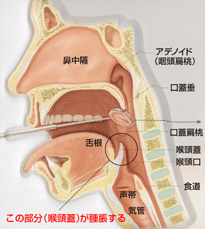 大阪府豊中市 おがわ耳鼻科 Ogawa Ear Nose Throat Clinic 当院で扱う疾患 ノドの病気 急性喉頭蓋炎